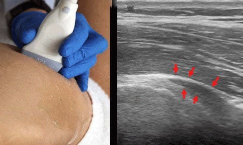 Slijmbeursontsteking-heup-echografie