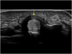 echografie triggervinger