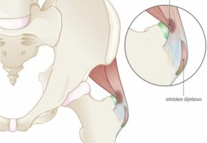 Illustratie van de heup met ontstoken slijmbeurs (bursitis trochanterica) en omliggende bilspierpezen