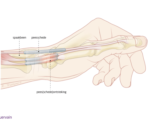 peesschede ontsteking van de Quervain