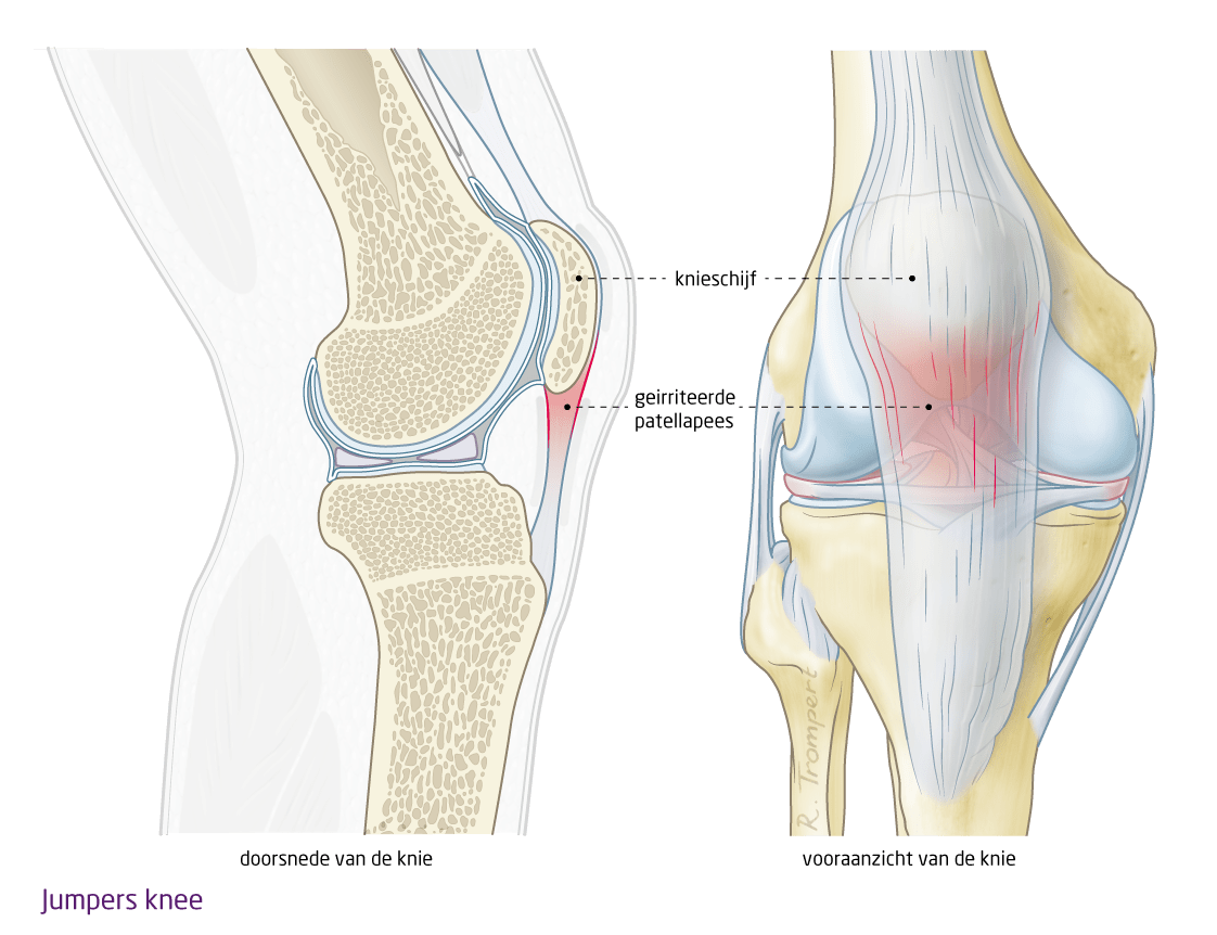 jumpers knee echozorg