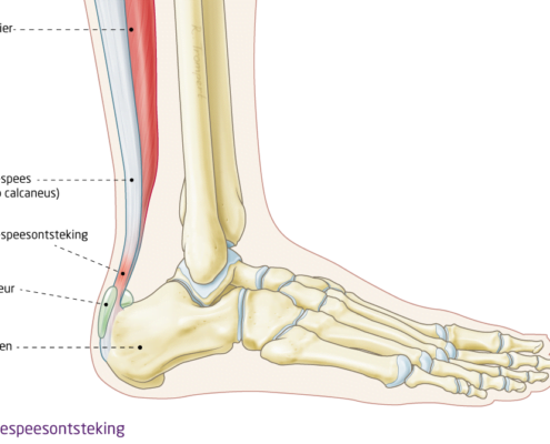 achillespees ontsteking