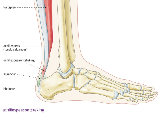 achillespees ontsteking