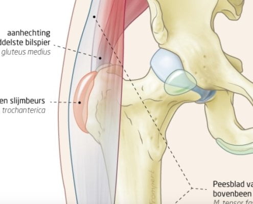 slijmbeursontsteking heup