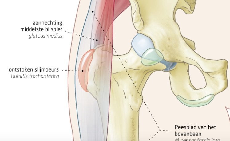 Anatomische illustratie van een slijmbeursontsteking heup (bursitis trochanterica) met gluteus medius en fascia lata