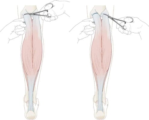 gastrocnemius-release