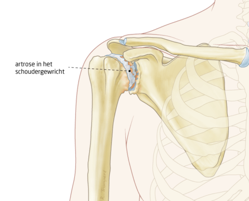 schouder artrose