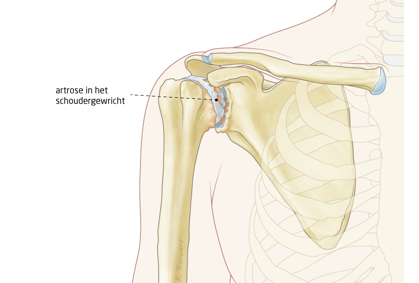 Anatomische illustratie van artrose van de schouder: slijtage van het kraakbeen tussen de schouderkop en schouderkom, met label "Slijtage van kraakbeen"