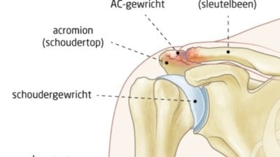 osteofyten-AC-gewricht