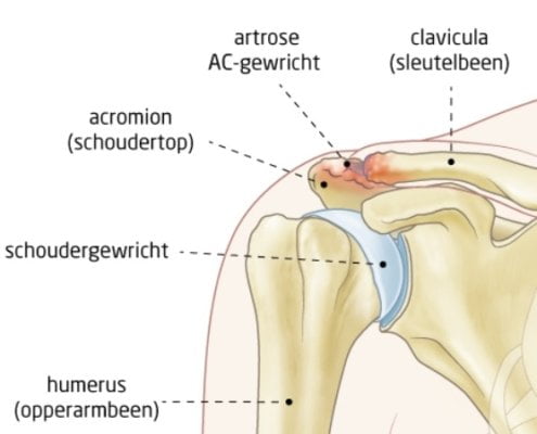 osteofyten-AC-gewricht