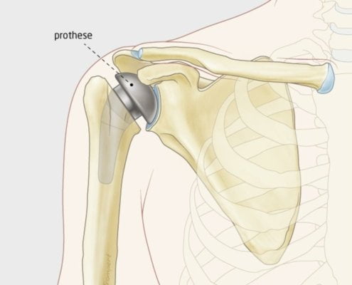 Resurfacing-schouder-prothese