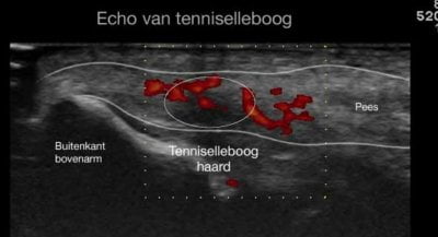 echografie-tenniselleboog-echozorg