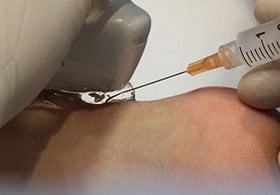 cortisone-injectie-achillespees ontsteking