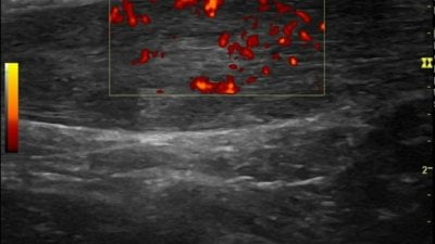 echografie-achillepees-ontsteking