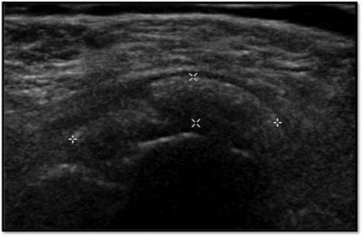 Echografisch beeld van een kalkafzetting in de schouderpees: witte heldere vlek met donkere schaduw, kenmerkend voor harde kalk bij tendinitis calcarea