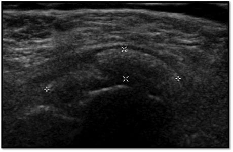 tendinitis calcarea