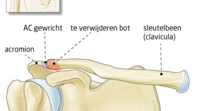 laterale-clavicularesectie
