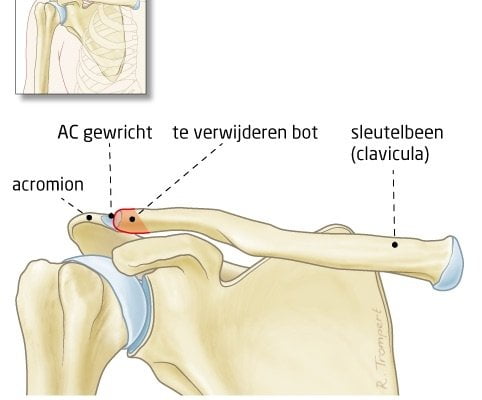 laterale-clavicularesectie