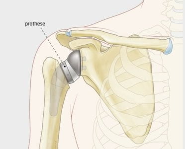 Anatomische illustratie van een omgekeerde schouderprothese: de metalen bol is bevestigd op het schouderblad en de plastic kom op de schouderkop van de bovenarm 