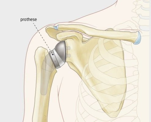 omgekeerde-schouder-prothese