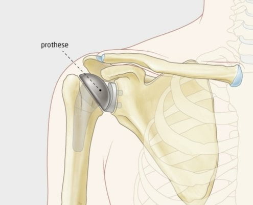 totale-schouder-prothese