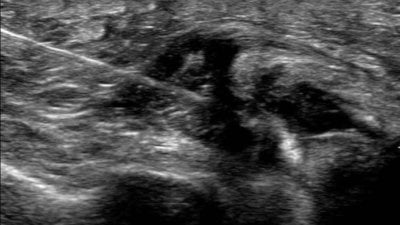 Echogeleide cortisone-injectie in de ruimte tussen de middenvoetsbeentjes bij een Mortons neuroom