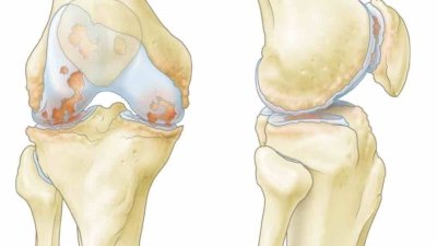 Anatomische illustratie van knieartrose: voor- en zijaanzicht met zichtbare kraakbeenslijtage in het kniegewricht