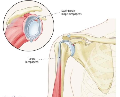 Biceps tendinitis