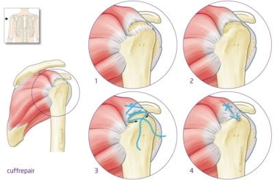 Een cuff repair is een operatie waarbij de gescheurde pees weer op de schouderkop wordt vastgehecht. Dit gebeurt tegenwoordig vrijwel altijd via een kijkoperatie. Tijdens de operatie Via kleine sneetjes brengt de chirurg een camera en instrumenten in de schouder. De schouderkop wordt opgeruwd zodat de pees goed kan vastgroeien. Daarna worden botankers in de schouderkop geplaatst en wordt de pees met hechtdraden teruggehecht. De operatie duurt ongeveer 1 uur en vindt plaats in dagbehandeling onder narcose. Herstel 6 weken: arm in mitella, dag en nacht 8 tot 10 weken: autorijden en fietsen weer mogelijk 3 maanden: arm tot schouderhoogte heffen 6 maanden: krachtoefeningen starten, arm boven schouderhoogte 1 jaar: eindresultaat bereikt Ongeveer 9 van de 10 patiënten is na een jaar tevreden met het resultaat. De kans op complicaties is klein, minder dan 1%. Wilt u meer weten over de operatie, de voorbereiding en het hersteltraject? Lees onze uitgebreide pagina over de cuff repair. Bij Orthozorg: Maarten de Vos is gespecialiseerd in schouderchirurgie en opereert in de Flexkliniek. U kunt snel bij hem terecht voor een operatief consult.