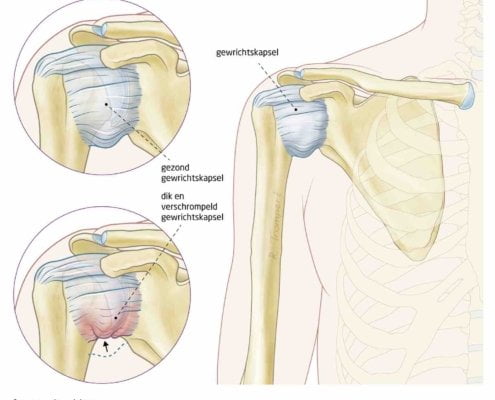 frozen shoulder