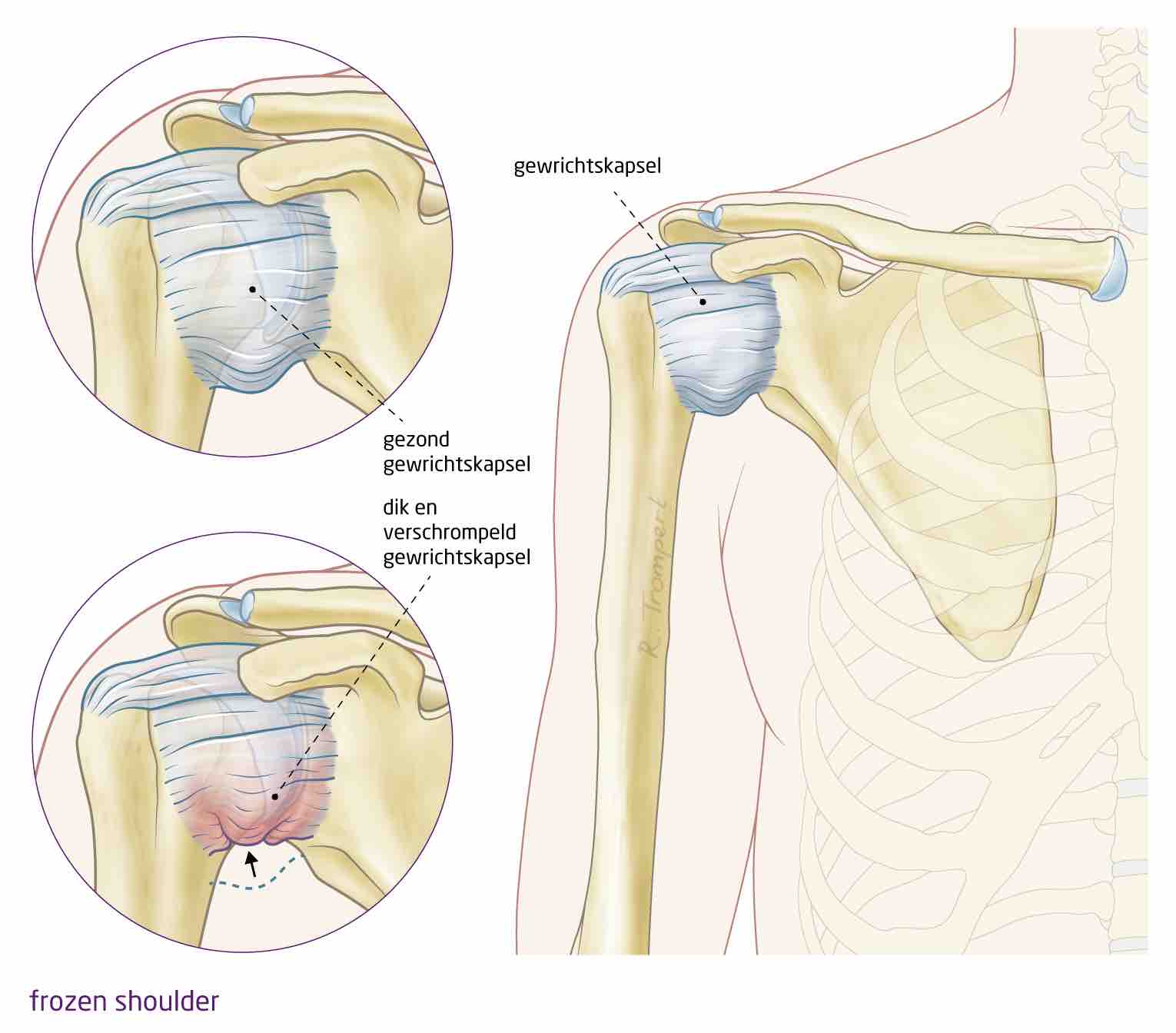 frozen shoulder