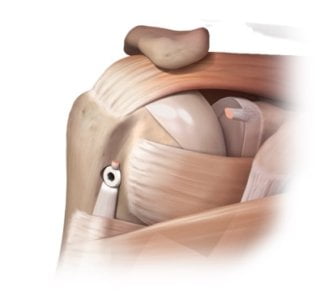 Illustratie van een biceps tenodese via kijkoperatie: de lange bicepspees wordt arthroscopisch losgemaakt en met een ankerschroef opnieuw vastgezet op de bovenarm