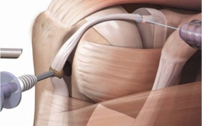 Illustratie van een biceps tenotomie via kijkoperatie: de lange bicepspees wordt arthroscopisch losgemaakt van zijn aanhechting in het schoudergewricht