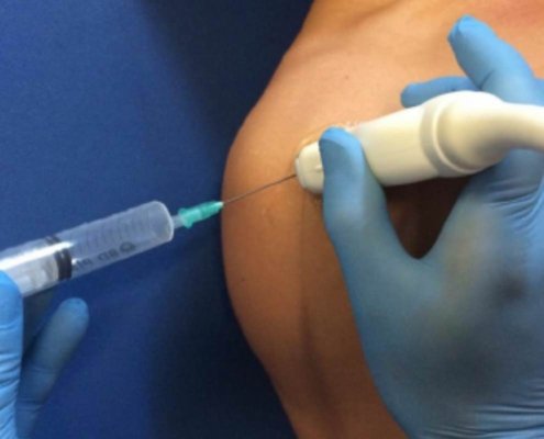 echogeleide injectie biceps tendinitis