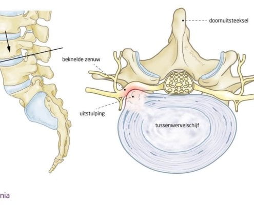 hernia