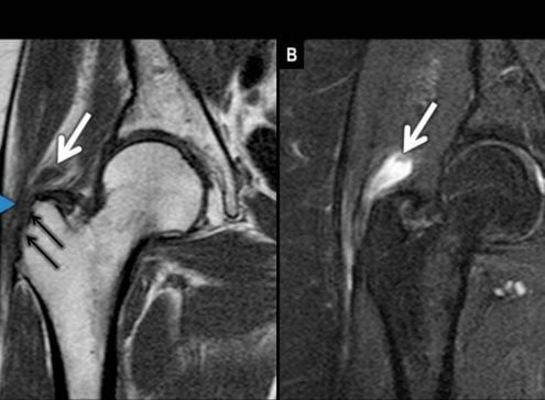 slijmbeursontsteking-heup-MRI