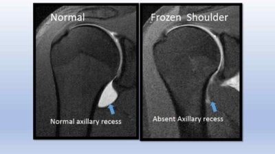 MRI vergelijking van een normale schouder en een frozen shoulder: links een normale axillary recess met vocht zichtbaar als witte vlek, rechts een frozen shoulder waarbij de axillary recess afwezig is door het verschrompelde gewrichtskapsel