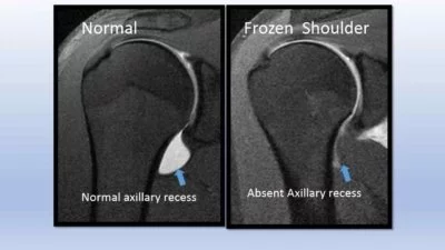 MRI vergelijking van een normale schouder en een frozen shoulder: links een normale axillary recess met vocht zichtbaar als witte vlek, rechts een frozen shoulder waarbij de axillary recess afwezig is door het verschrompelde gewrichtskapsel