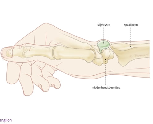 ganglion pols