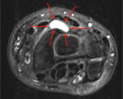 MRI ganglion