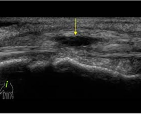 peesschede ganglion