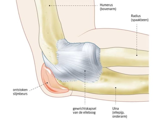 slijmbeursontsteking elleboog