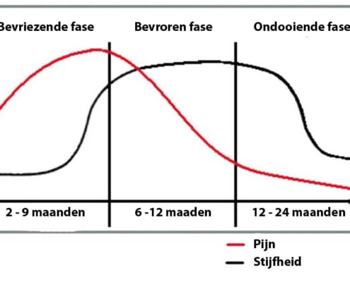 frozen shoulder fases echozorg
