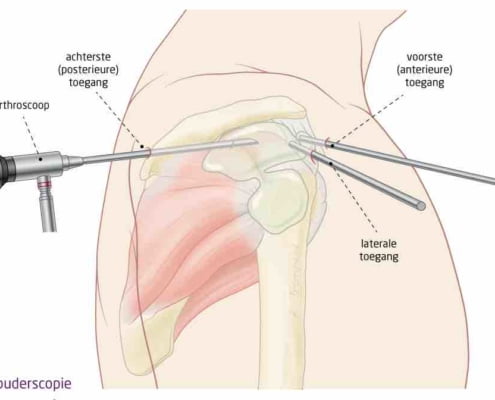 frozen shoulder operatie