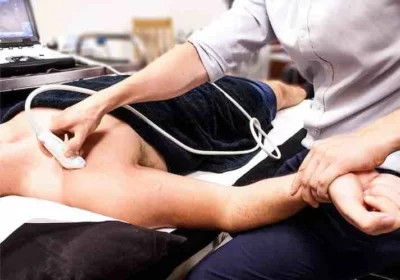 Anatomische illustratie van de rotator cuff: de vier schouderpezen onder het schouderdak, met rechts de supraspinatuspees die ingeklemd raakt bij het heffen van de arm