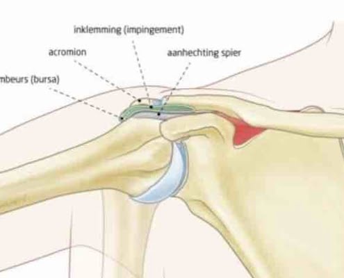schouder peesontsteking