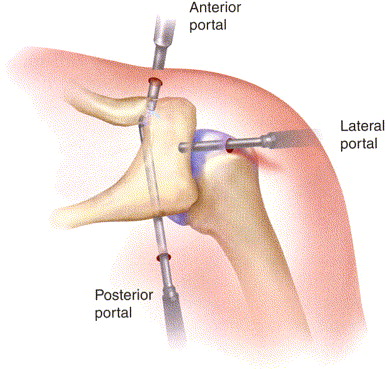 laterale clavicula resectie kijkoperatie echozorg