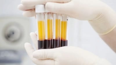 Buisjes bloedplasma (ACP/PRP) klaargemaakt voor een echogeleide injectie bij een chronische peesontsteking in de schouder