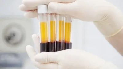 Buisjes bloedplasma (ACP/PRP) klaargemaakt voor een echogeleide injectie bij een chronische peesontsteking in de schouder