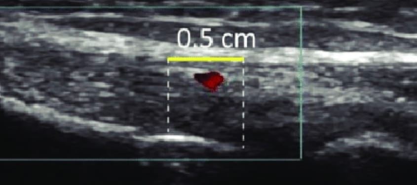 Echo acute peesontsteking fase 1